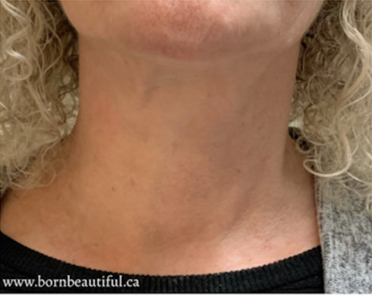 After — Neck & Jowl Skin Tightening