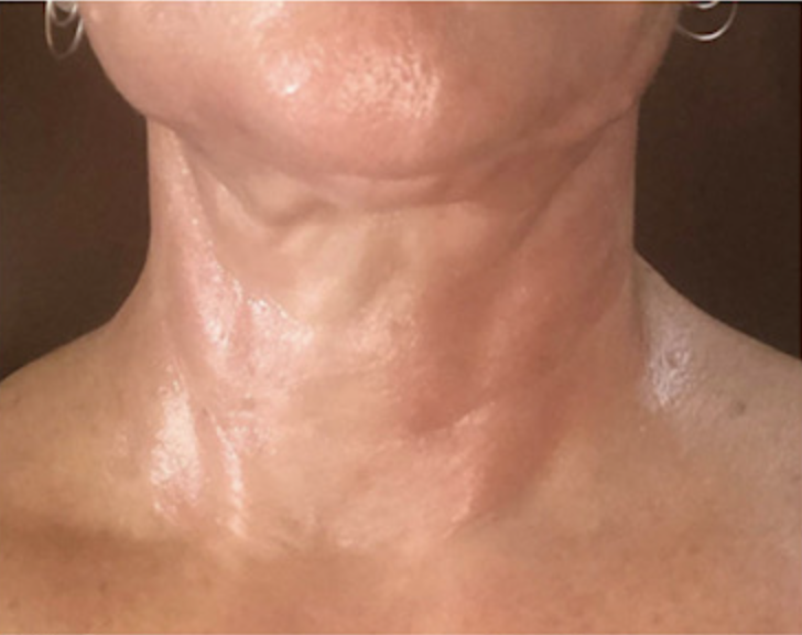 Before — Neck & Jowl Skin Tightening