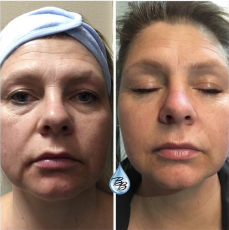 Full Face Resurfacing