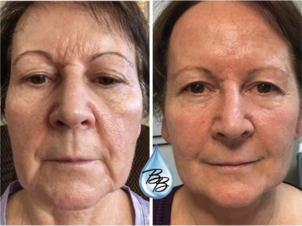 Full Face Resurfacing