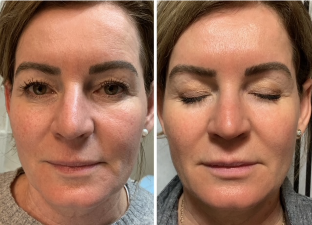 Full Face Resurfacing