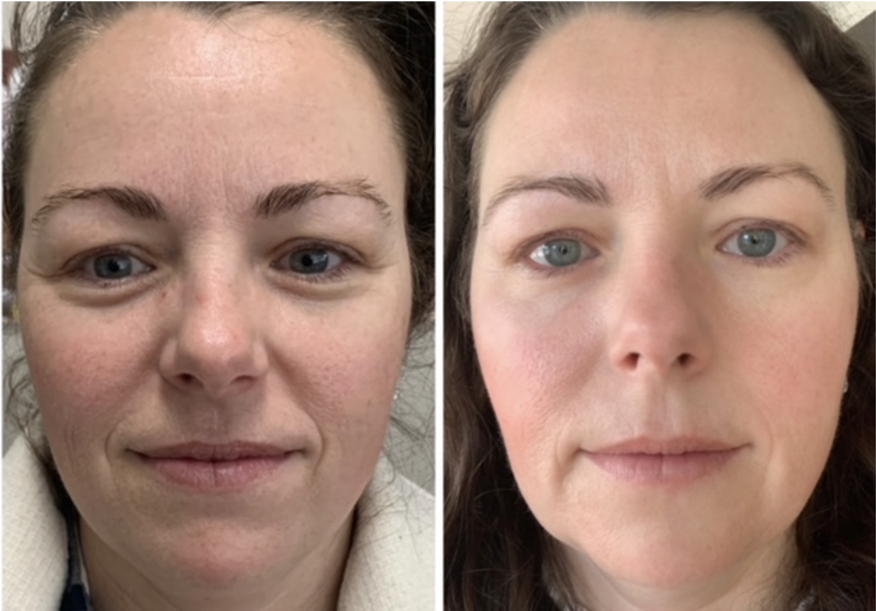 Skin Rejuvenation