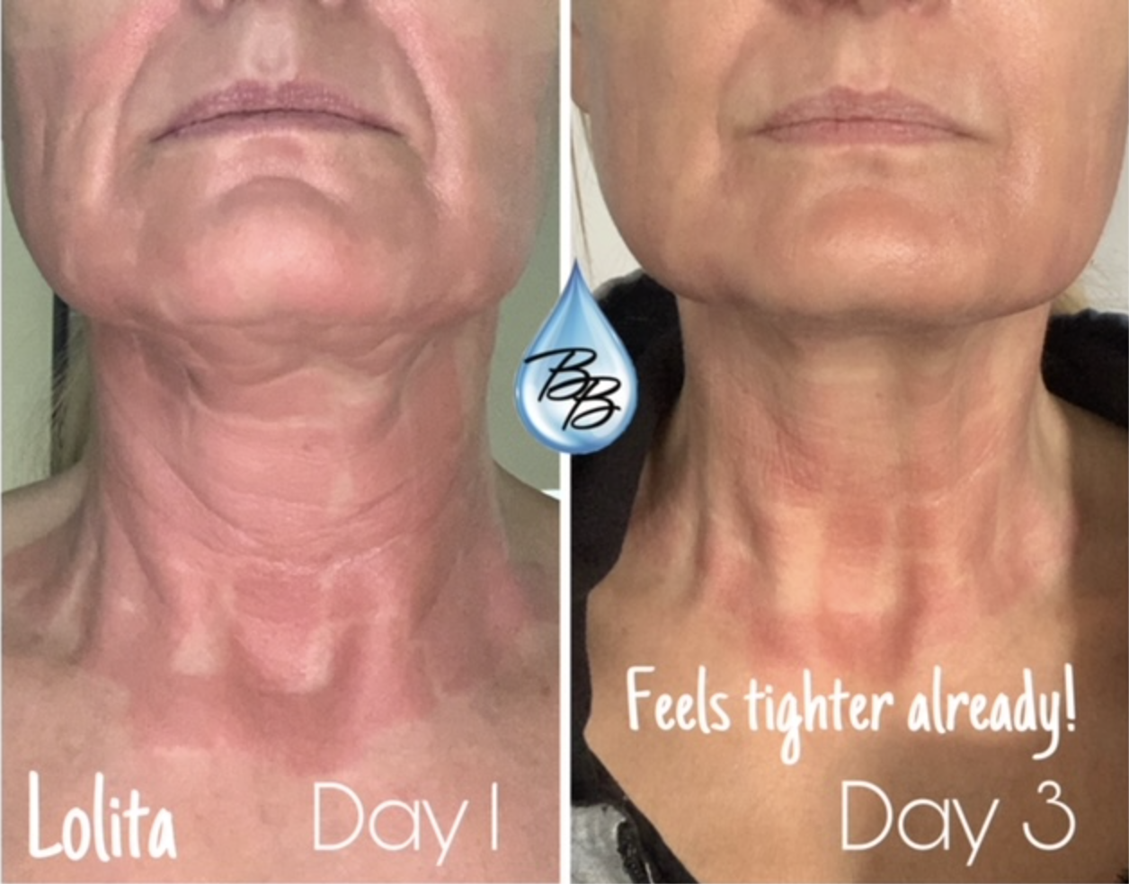 Lolita's Neck & Jowl Skin Tightening