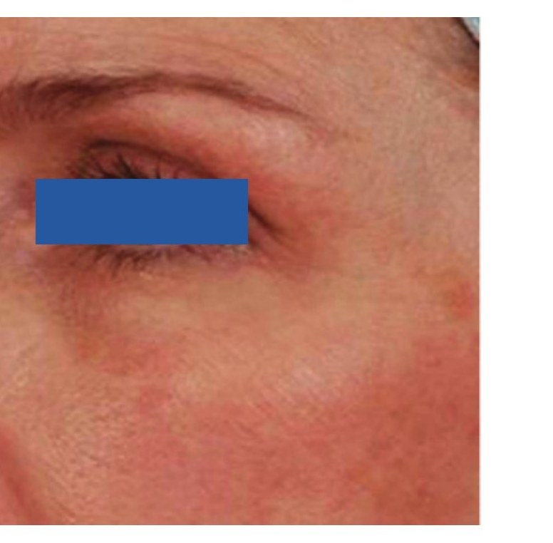 After — Periorbital Wrinkles