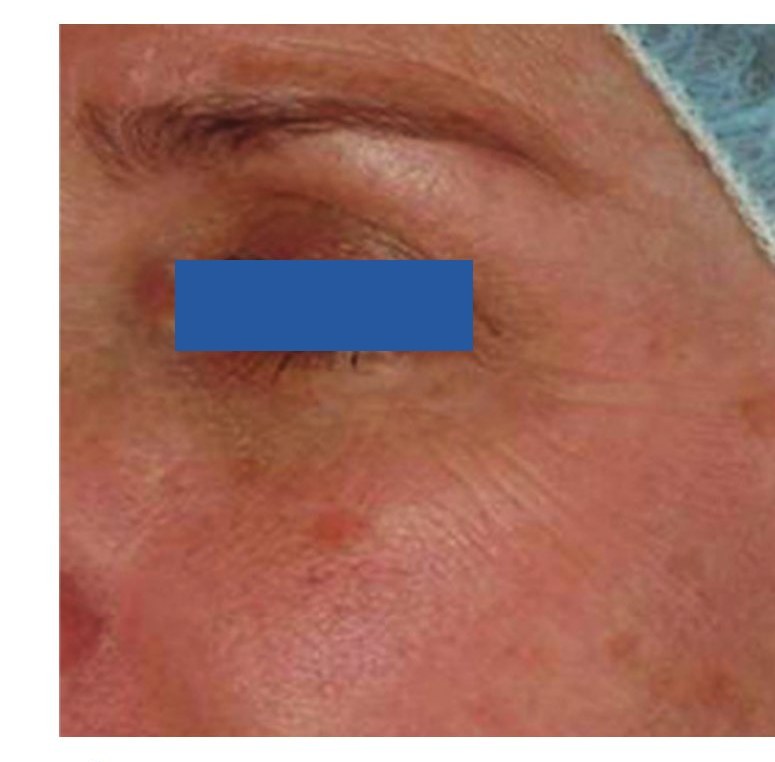 Before — Periorbital Wrinkles
