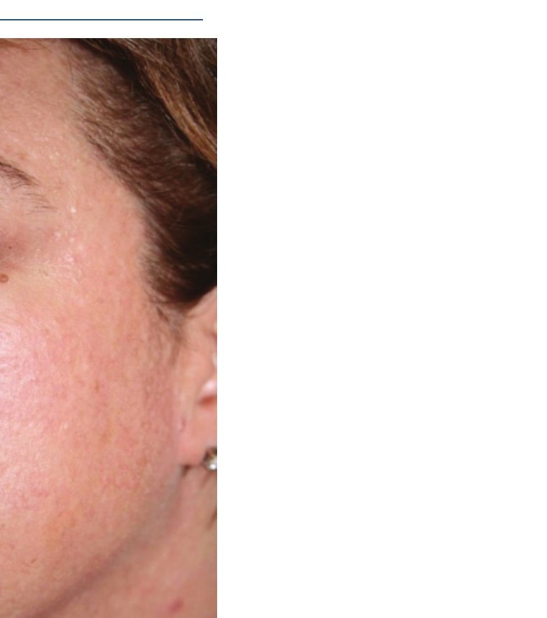 After — Full Face Texture & Redness