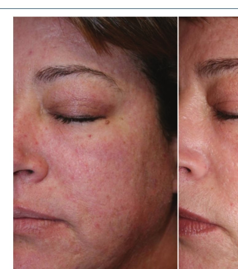 Before — Full Face Texture & Redness