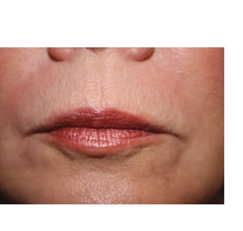 After — Perioral Lines