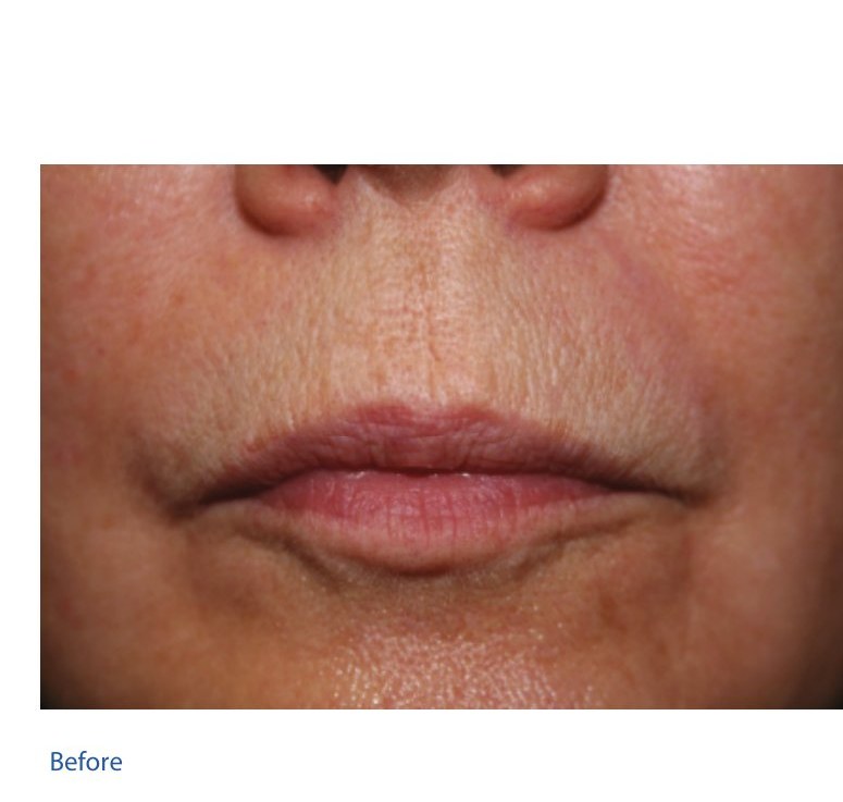Before — Perioral Lines