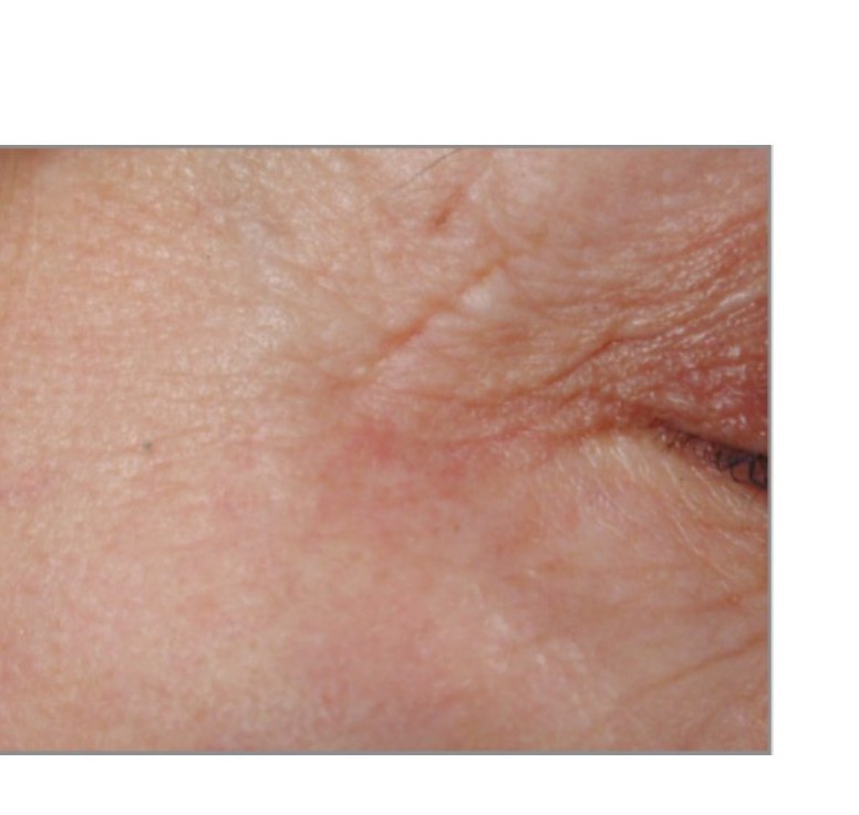 After — Crow's Feet