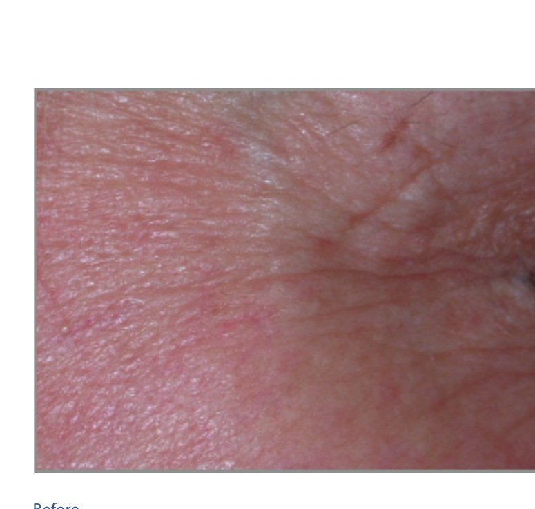 Before — Crow's Feet