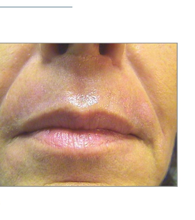 After — Skin Texture Improvement