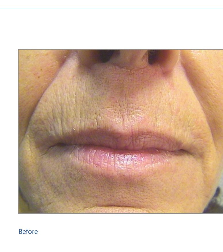 Before — Skin Texture Improvement