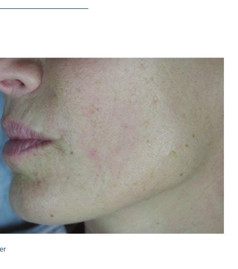 After — Advanced Resurfacing