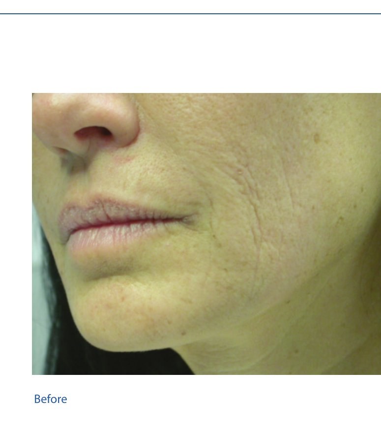Before — Advanced Resurfacing